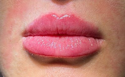 Lip Filler Before & After Gallery - Patient 420531 - Image 2