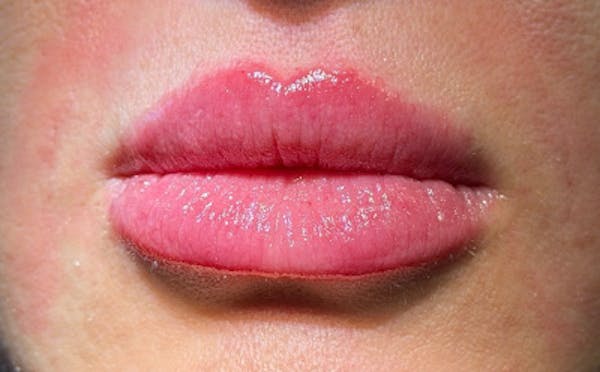 Lip Filler Before & After Gallery - Patient 420531 - Image 2