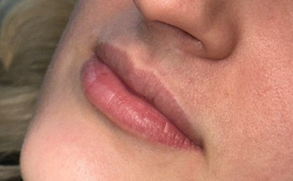 Lip Filler Before & After Gallery - Patient 404065 - Image 1