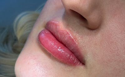Lip Filler Before & After Gallery - Patient 404065 - Image 2