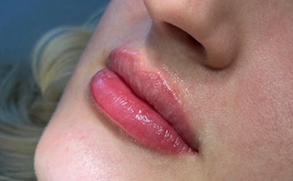 Lip Filler Before & After Gallery - Patient 404065 - Image 2