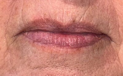 Lip Filler Before & After Gallery - Patient 264051 - Image 1
