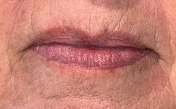 Lip Filler Before & After Gallery - Patient 264051 - Image 1