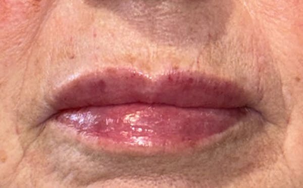Lip Filler Before & After Gallery - Patient 264051 - Image 2