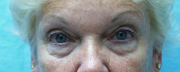 Blepharoplasty Before & After Gallery - Patient 23532691 - Image 1