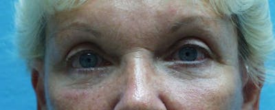 Blepharoplasty Before & After Gallery - Patient 23532691 - Image 2