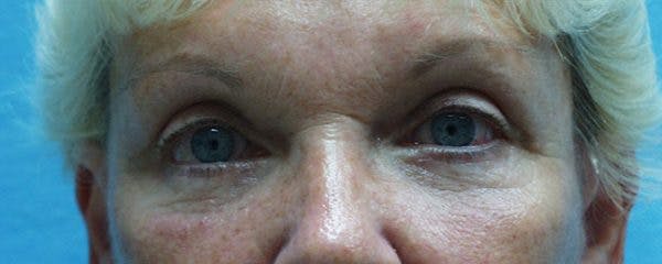 Blepharoplasty Before & After Gallery - Patient 23532691 - Image 2