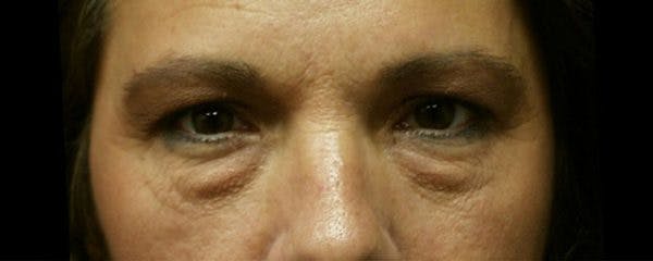 Blepharoplasty Before & After Gallery - Patient 23532692 - Image 1