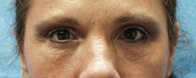 Blepharoplasty Before & After Gallery - Patient 23532692 - Image 2