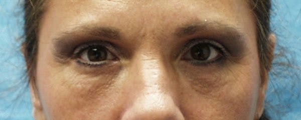 Blepharoplasty Before & After Gallery - Patient 23532692 - Image 2