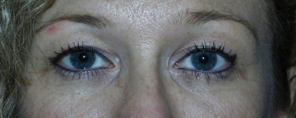 Blepharoplasty Before & After Gallery - Patient 23532693 - Image 1