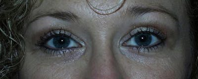 Blepharoplasty Before & After Gallery - Patient 23532693 - Image 2