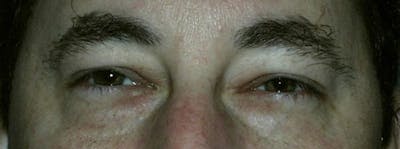 Blepharoplasty Before & After Gallery - Patient 23532695 - Image 1