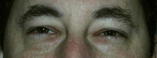 Blepharoplasty Before & After Gallery - Patient 23532695 - Image 1