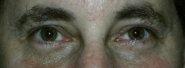 Blepharoplasty Before & After Gallery - Patient 23532695 - Image 2