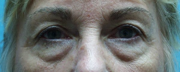 Blepharoplasty Before & After Gallery - Patient 23532696 - Image 1