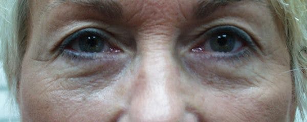 Blepharoplasty Before & After Gallery - Patient 23532696 - Image 2