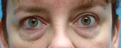 Blepharoplasty Before & After Gallery - Patient 23532697 - Image 1