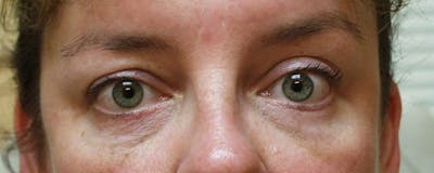 Blepharoplasty Before & After Gallery - Patient 23532697 - Image 2