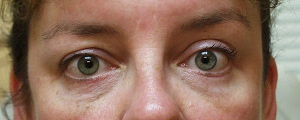 Blepharoplasty Before & After Gallery - Patient 23532697 - Image 2