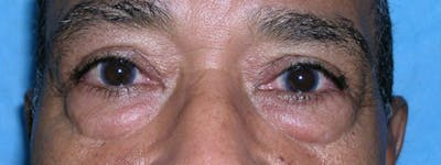 Blepharoplasty Before & After Gallery - Patient 23532699 - Image 1