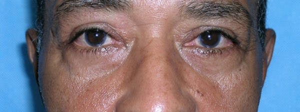 Blepharoplasty Before & After Gallery - Patient 23532699 - Image 2
