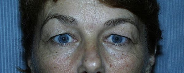 Blepharoplasty Before & After Gallery - Patient 23532701 - Image 1