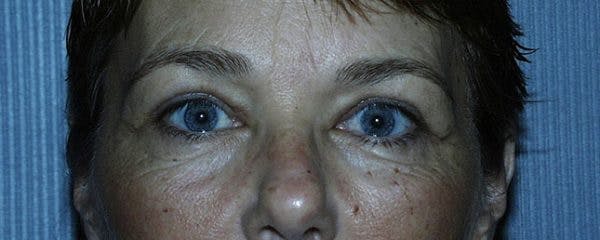 Blepharoplasty Before & After Gallery - Patient 23532701 - Image 2