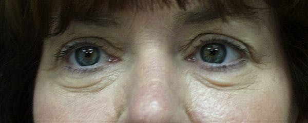 Blepharoplasty Before & After Gallery - Patient 23532702 - Image 1