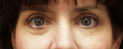 Blepharoplasty Before & After Gallery - Patient 23532702 - Image 2