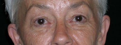 Blepharoplasty Before & After Gallery - Patient 23532707 - Image 1