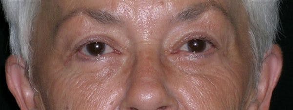 Blepharoplasty Before & After Gallery - Patient 23532707 - Image 2