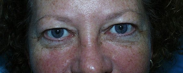 Blepharoplasty Before & After Gallery - Patient 23532714 - Image 1