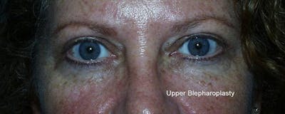 Blepharoplasty Before & After Gallery - Patient 23532714 - Image 2