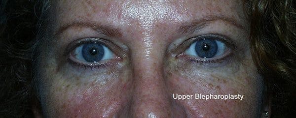 Blepharoplasty Before & After Gallery - Patient 23532714 - Image 2