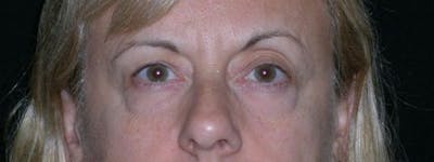 Blepharoplasty Before & After Gallery - Patient 23532716 - Image 1