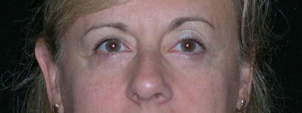 Blepharoplasty Before & After Gallery - Patient 23532716 - Image 2