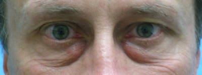 Blepharoplasty Before & After Gallery - Patient 23532721 - Image 1