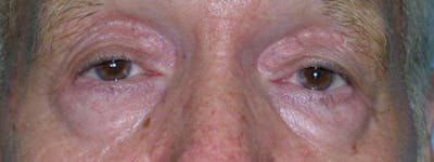 Blepharoplasty Before & After Gallery - Patient 23532727 - Image 1