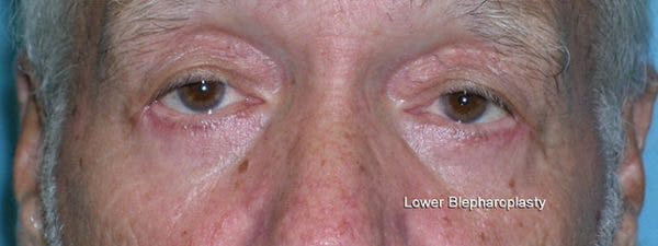 Blepharoplasty Before & After Gallery - Patient 23532727 - Image 2