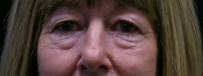 Blepharoplasty Before & After Gallery - Patient 23532728 - Image 1