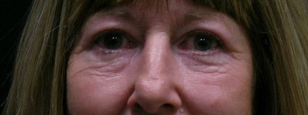 Blepharoplasty Before & After Gallery - Patient 23532728 - Image 2