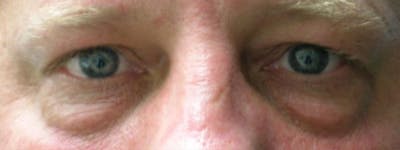 Blepharoplasty Before & After Gallery - Patient 23532738 - Image 1
