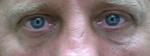 Blepharoplasty Before & After Gallery - Patient 23532738 - Image 2