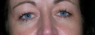 Blepharoplasty Before & After Gallery - Patient 23532741 - Image 1