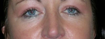 Blepharoplasty Before & After Gallery - Patient 23532741 - Image 2