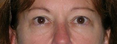 Blepharoplasty Before & After Gallery - Patient 23532751 - Image 1
