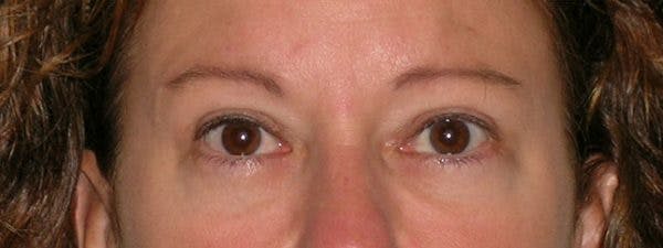 Blepharoplasty Before & After Gallery - Patient 23532751 - Image 2