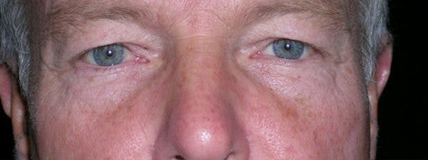 Blepharoplasty Before & After Gallery - Patient 23532756 - Image 1