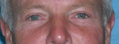 Blepharoplasty Before & After Gallery - Patient 23532756 - Image 2
